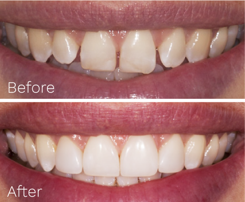 Befre and after dental veneers