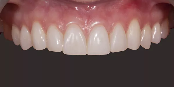 close up image of teeth after composite bonding treatment.