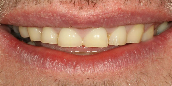 worn down yellow teeth before treatment.