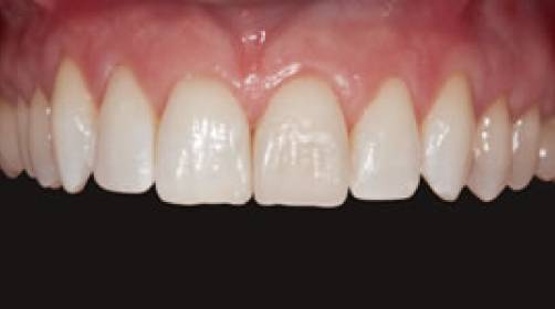 smile restored by composite bonding.
