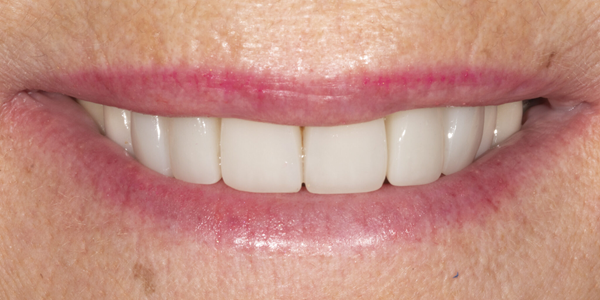 Composite bonding has straightened the teeth and improved the smile.