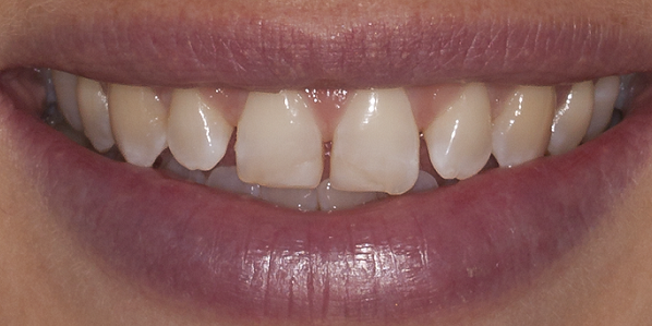 Close up of misshaped teeth with gaps
