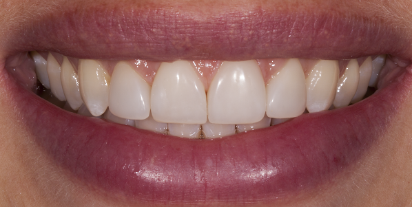 Gaps reduced and teeth reshaped with Andrea Ubhi composite bonding.